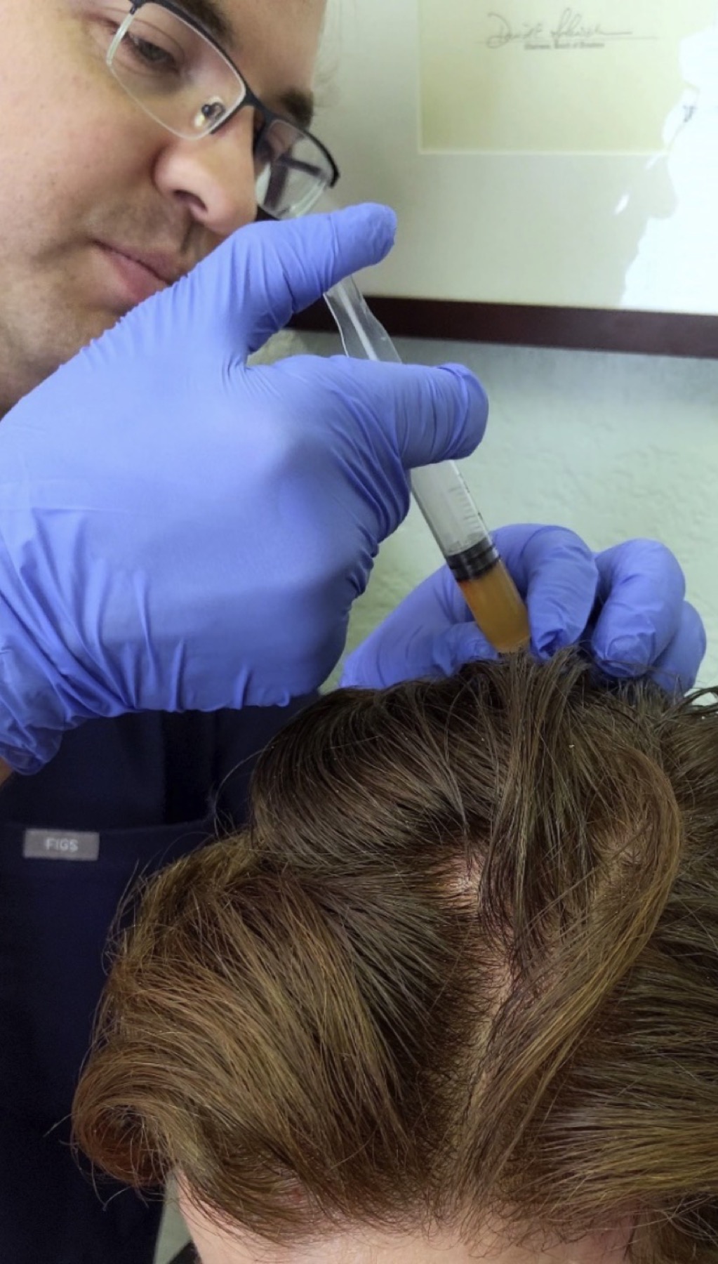 Dr. Sean performing PRP injections for hair restoration